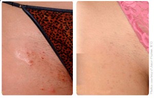 Laser Hair Removal – evole Mediclinic