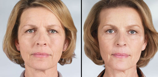 sculptra before/after