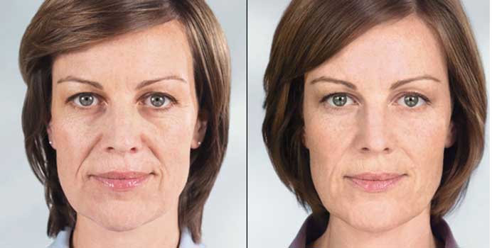 sculptra before after