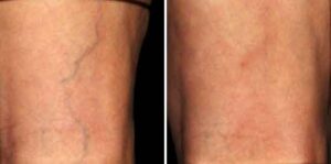 sclerotherapy